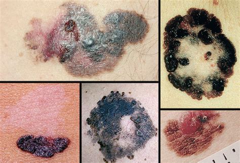 Learn more about the different ways melanoma can appear on your body and see images of what it can look importantly, melanoma appears in many different ways. Skin Cancers