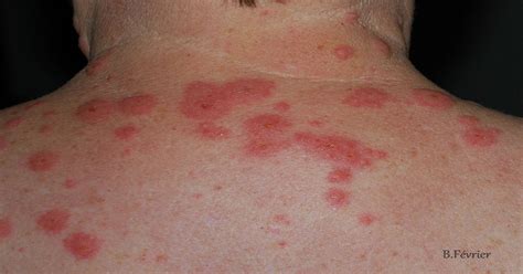 Allergie Au Soleil Causes Et Remèdes Sport Et Santé