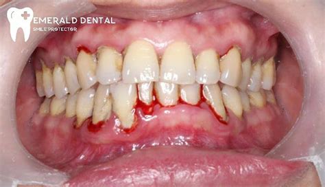 Bleeding Gums Emerald Dental