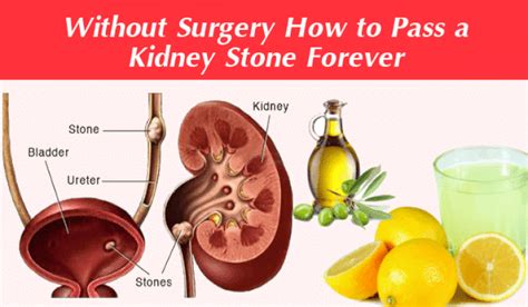 How To Develop A Kidney Stone Askworksheet