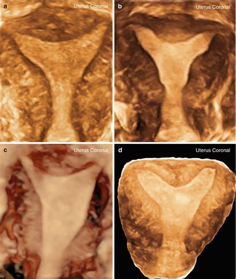 Ultrasound Evaluation Of Congenital Uterine Anomalies Obgyn Key