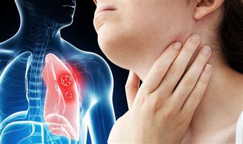 Lung Cancer Symptoms Signs Of A Tumour Include Having Swollen Glands