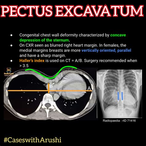 The Answer To The Last Spotter Is Here Pectus Excavatum Also Known As
