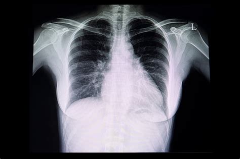 Una Radiograf A De T Rax De Un Paciente Con Cardiomegalia Foto Premium