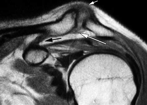 Mr Imaging Appearances Of Acromioclavicular Joint Dislocation