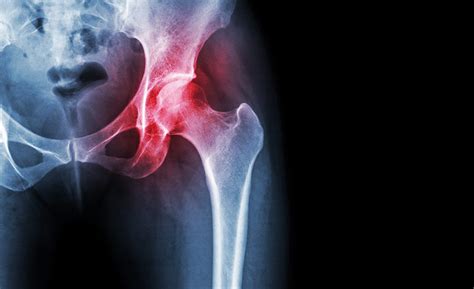 Common Hip Injuries Symptoms And Treatment