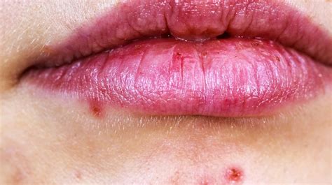 How To Treat Infected Blackhead On Lip Howtormeov
