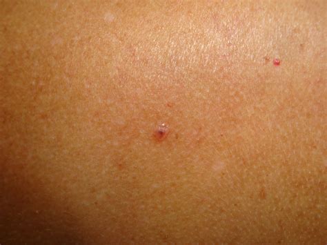 Skin Cancer Spots On Upper Leg