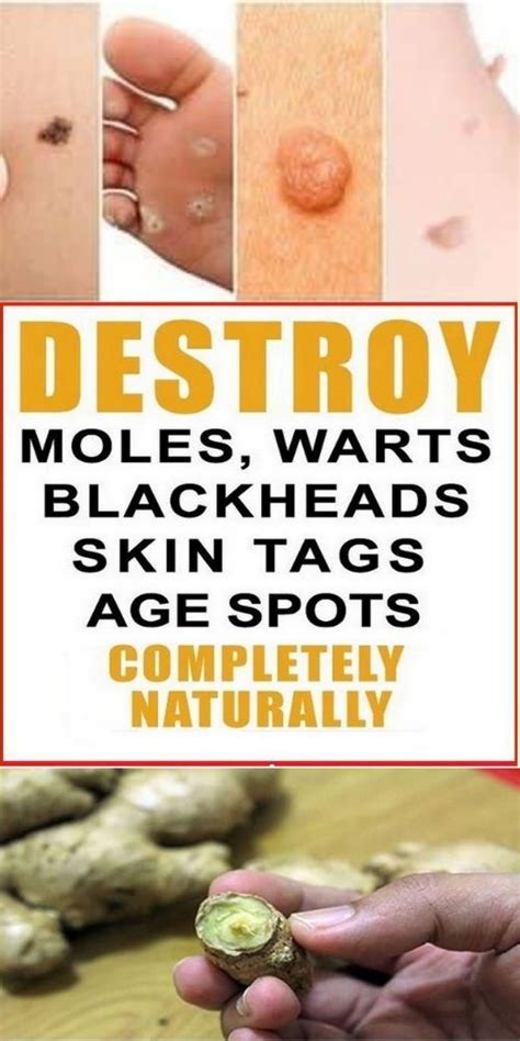 Destroy Your Moles Warts Blackheads Skin Tags And Age Spots