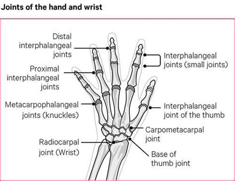 Osteoarthritis Oa Of The Hand And Wrist