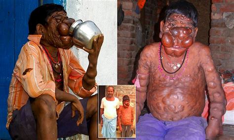 Apr 27, 2021 · the canadian red cross is offering support to the indian red cross to deliver assistance and support to communities affected or at risk of being affected by the virus. Indian boy whose body is covered in tumours believes 'the ...