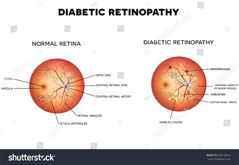 Diabetic retinopathy and normal eye retina. | Eye retina, Diabetic