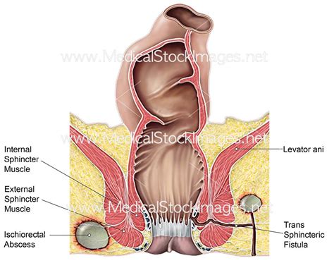 Ischiorectal Abscess Labelled Medical Stock Images Company