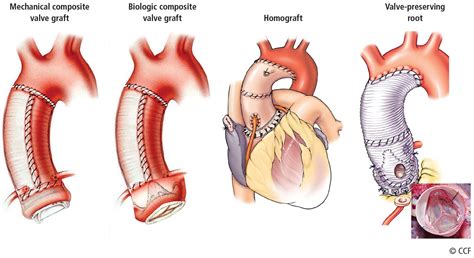 Aortic Replacement In Cardiac Surgery Cleveland Clinic Journal Of Medicine