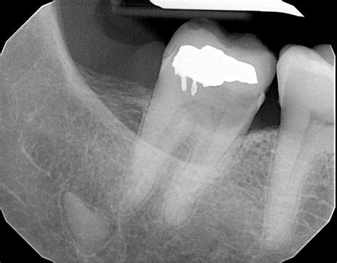 Oral Pathology Case Venous Blue Lake Mole—what Dentistryiq