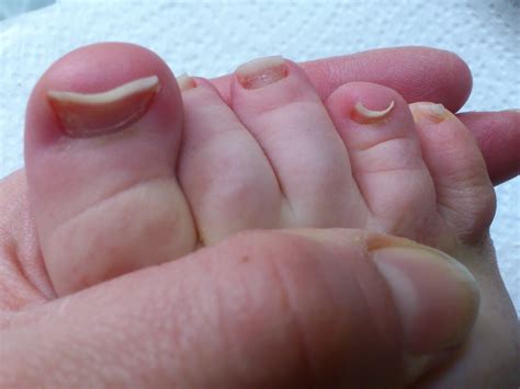 Melanoma On Toes Pictures Photos