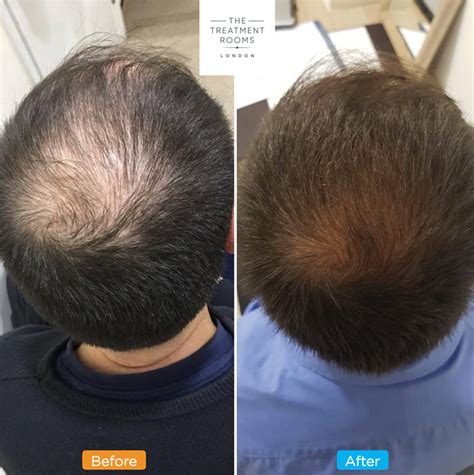 Maybe you would like to learn more about one of these? Crown Hair Transplant - The Treatment Rooms London