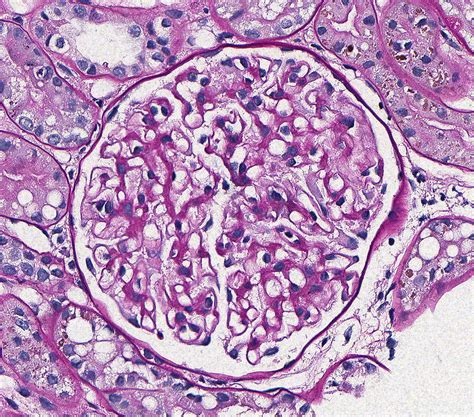 Membranous Glomerulonephropathy Atlas Of Renal Lesions In Proteinuric