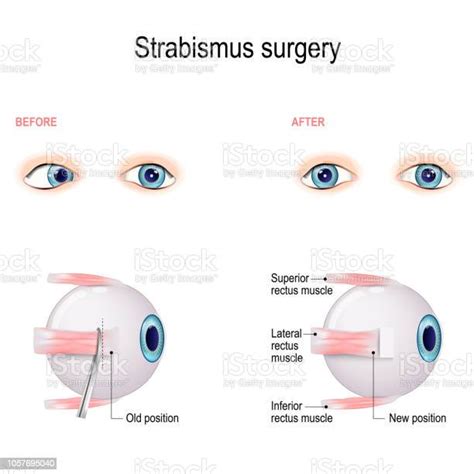 Strabismus Surgery Eye Muscle Recession Extraocular Muscle Anatomy