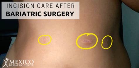 Incision Care After Bariatric Surgery Healing And Recovery