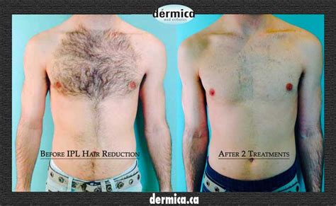 Mens Laser Hair Removal Edmonton Phototherapy