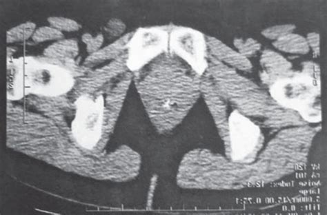 Computed Tomography In The Inguinal Region A Clearly Demarcated