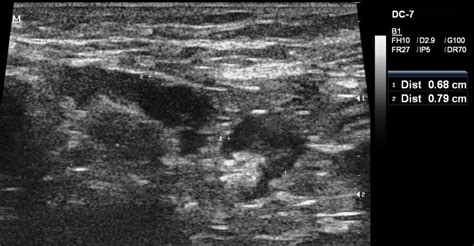 Ultrasonography Of Left Axilla Showing Necrotic Lymph Nodes Download