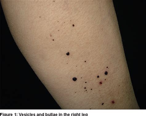 Figure 1 From Bullous Hemorrhagic Dermatosis Induced By Enoxaparin