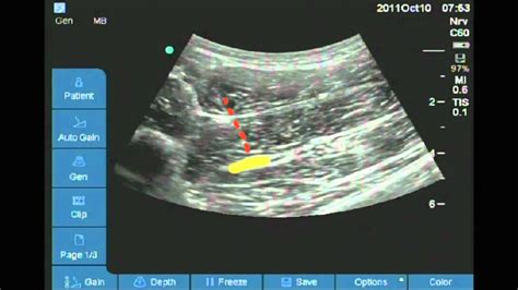 Ultrasound Guided Anterior Sciatic Nerve Block Youtube