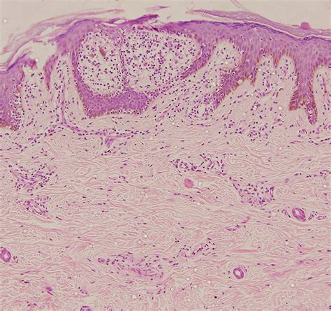 Epidermis Shows Mild Focal Parakeratosis Enlarged Rete Pegs Expanded