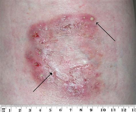 A Woman With A Sore Spot On Her Leg The Bmj