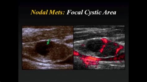 Cervical Lymph Nodes Lymph Nodes Ultrasound Cervical