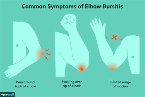 Elbow Bursitis Symptoms Causes And Treatment