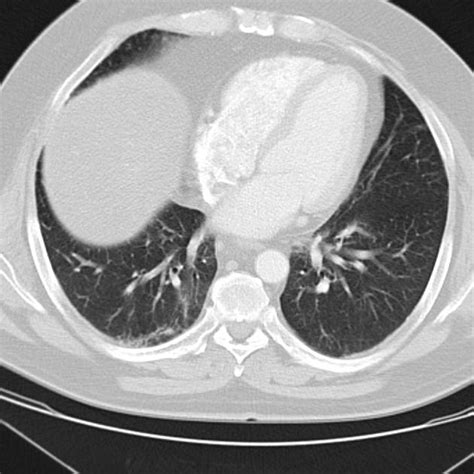 Radiation Induced Pulmonary Fibrosis Radiology Case