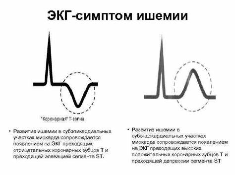 Диета при ишемии сердца стенокардии Ишемическая болезнь сердца Стенокардия лекция для курсантов 3 Ишемическая болезнь сердца Стенокардия лекция для курсантов 3 Диета при ишемии сердца стенокардии