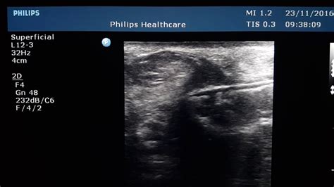 Fetal Umbilical Hernia Ultrasound