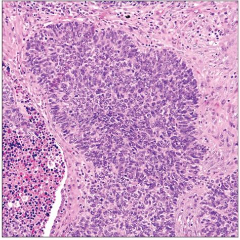 Poorly Differentiated Squamous Carcinoma Small Cell Variant
