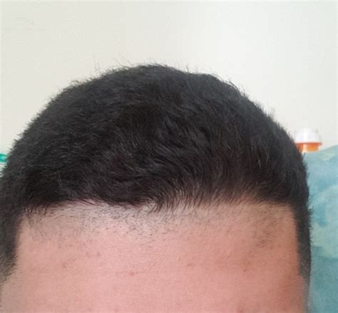 Barber Pushed Back My Hairline A Few Months Ago And Its Barely Growing