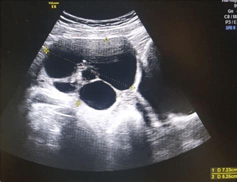 Ultrasound Aspect Of A Mutilocular Ovarian Cyst Of 72 Mm Download