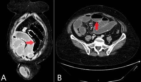 Cureus A Rare Presentation Of Small Bowel Obstruction Due To Obstructed Indirect Inguinal Hernia