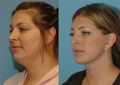 The amount of time the material in a pod lasts is dependent on a couple of factors, including the length of. Mini facelift newport beach. Orange County Mini Facelift ...