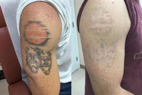 How Long After Laser Tattoo Removal Will Tattoo Fade Tannerringuette