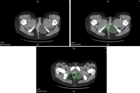Atypical Presentation Of A Vaginal Epithelial Inclusion Cyst Journal