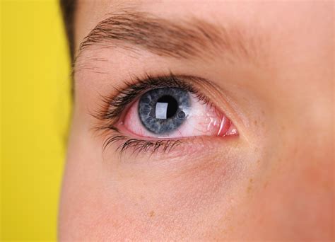 Pink Eye Conjunctivitis Symptoms And Complications