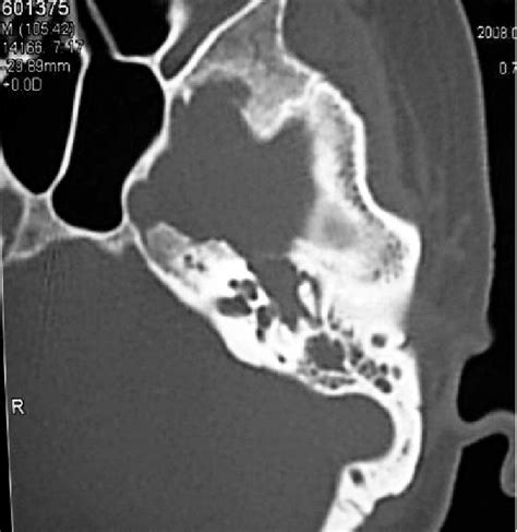 Axial Section Ct Of Case 1 Reveals The Soft Tissue Mass On The Left