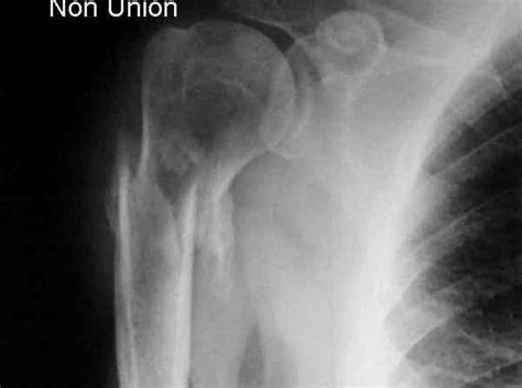 Non Union Of Humeral Fractures Wheeless Textbook Of Orthopaedics