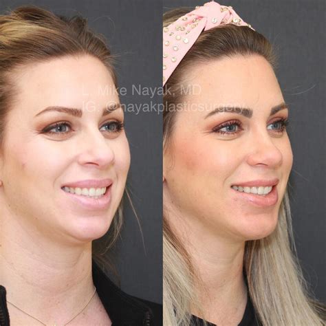 Chin Implants Before And After Patient 07 Nayak Plastic Surgery