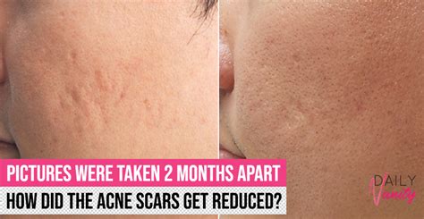 Acne Scar Removal In Singapore The Clifford Aesthetics Tell Us What It