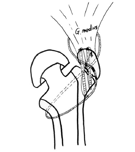 Schematic Figure For Fixation Technique Of Greater Trochanter With