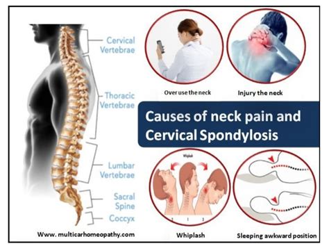 What Is Cervical Spondylosis Causes Risk Factors Of Condition How To